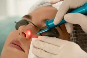 A woman having facial laser