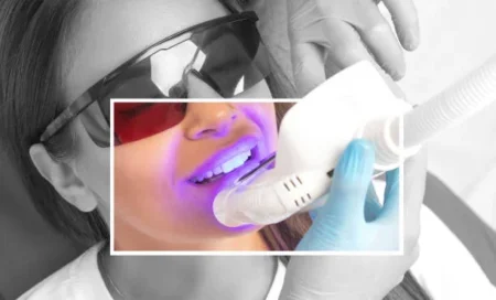teeth whitening process