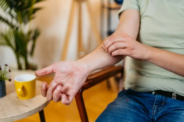 Say Bye to Mosquito Bite Itches With Hydrocolloid Patches A man scratching on his arm